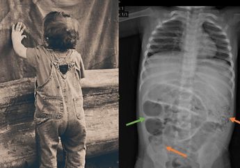 Astaghfirullah, Perut Anak 3 Tahun di Jember Membesar Tiba-tiba, Dokter Syok Saat Temukan Hewan Ini