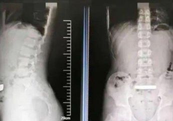 Bocah 11 Tahun Telan Emas Murni Seberat 100 Gram, Dokter Syok Lihat Kondisinya