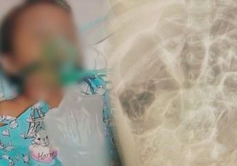 Penyebab Tubuh Bocah 4 Tahun Dipenuhi Cacing hingga Meninggal Dunia di Sukabumi