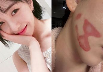 Kronologi Kwon Mina Eks AOA Alami Luka Bakar Saat Jalani Perawatan Wajah, Siap Tempuh Jalur Hukum