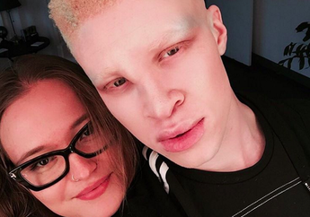 10 Model Albino yang Sukses di Dunia Fashion
