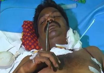 Ajaib, Kecelakaan dan Tertusuk Besi Dari Leher Hingga Mulut, Pengendara Sepeda Motor Ini Kembali Pulih!