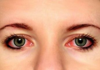 Mata Iritasi Setelah Menggunakan Bulu Mata Palsu? Mungkin Inilah Penyebabnya