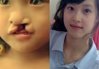 Kisah Gadis yang Dibuang Orang Tuanya Karena Bibirnya Sumbing, Setelah Tumbuh Dewasa Gini Balasannya