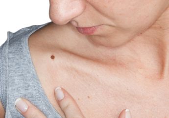 Kenali Penyakit Kanker Melanoma, Bisa Kamu Deteksi dengan Modal Cermin dan Hair Dryer, loh!