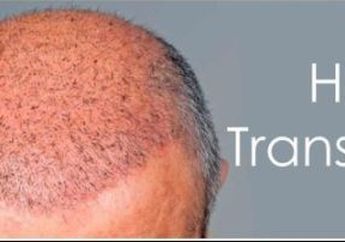 Transplantasi Rambut Solusi untuk Kebotakan?