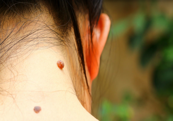 Yuk Intip Makna Tanda Lahir yang Ada di Tubuh Kamu! Nomor 5 Beruntung Banget