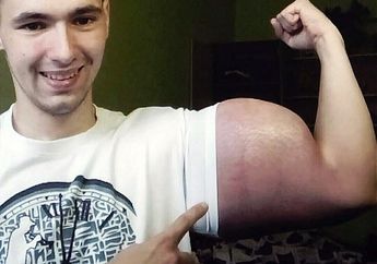 Lengannya Seperti Popeye,  Pria Ini Terancam Diamputasi, Ternyata Ini Faktanya 