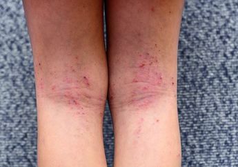 Bikin Makin Parah, Jangan Lakukan Hal Ini Kalau Punya Eksim!