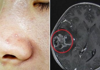 Mengerikan, Hanya Karena Memencet Jerawat di Hidung, Seorang Bocah Perempuan Mengalami Infeksi Otak