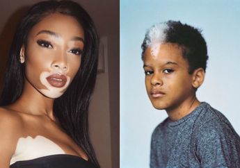 Sebetulnya Karena Kelainan Genetik, Tapi Penampilan 10 Manusia Ini Justru Jadi Begitu Indah