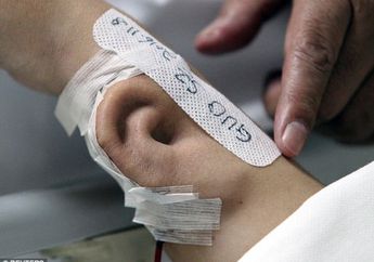 Beneran Nih! Dokter Ini Ganti Telinga Pasiennya Yang Hilang, Caranya Kamu Nggak Akan Percaya