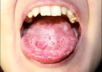 Waspada! Kamu Juga Wajib Tahu Tentang Infeksi Candida yang Bisa Menyerang Tubuhmu Ini