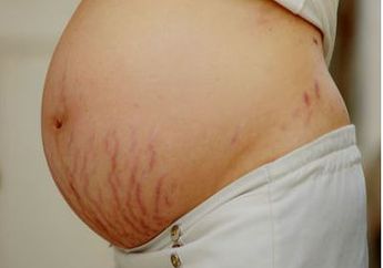 Ternyata Ini Perbedaan Stretch Mark Warna Merah dan Putih yang Wajib Kamu Tahu