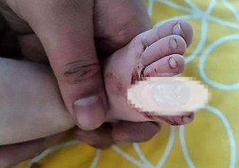 Gara-gara Rambut Ibunya, Kondisi Jari Kaki Bayi Jadi Begini