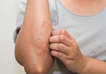 Mengalami Eksim pada Kulit? Jangan lakukan Hal Ini Karena Bisa Bikin Makin Parah!