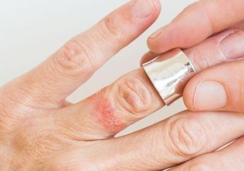 Atasi Ruam Kulit dengan Cara Ini, Gampang Banget dan Bisa Dilakukan di Rumah, Mau Tahu?