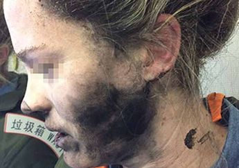 NGERI! Kuping Wanita Ini Terbakar Ketika Menggunakan Earphone Saat di Pesawat