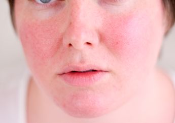 3 Langkah Menyiasati Kulit Kemerahan dengan Makeup