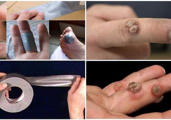 Ternyata Lakban Bisa Menghilangkan Kutil, Coba Saja Begini Caranya