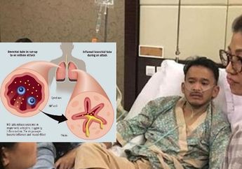 Awas! Bisa Menyerang Siapa Saja, Yuk Intip Gejala Penyakit yang Diderita Ruben Onsu