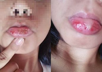 Kena Iming-iming Lipstik Murah, Bibir Gadis Ini Malah Bengkak Parah