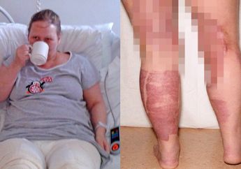 Cukur Bulu Organ Genital, Seorang Wanita Menderita Infeksi Bakteri Pemakan Daging 