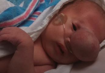 Benjolan di Muka Bayi Ini Hilang, Lihat Wajah Imut yang Bikin Ibunya Tak Kuasa Menahan Tangis