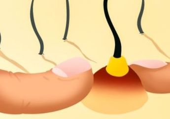 Ini 5 Mitos Tentang Jerawat yang Perlu Kamu Ketahui