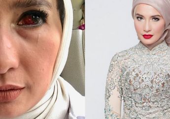 Ouch! Pembuluh Darah Mata Arzeti Bilbina Pecah Mendadak, Begini Kondisinya Sekarang