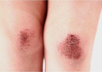 Otot Kaku Karena Luka? Atasi dengan Cara Ini, Mau Tahu?