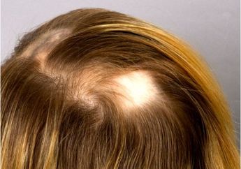 Penyakit Ini Bisa Bikin Kepala Plontos Tanpa Rambut, Apa ya Kira-kira?