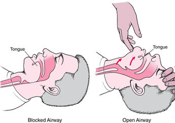 Jangan Sampai Salah, Pelajari Cara Memberi Nafas Buatan