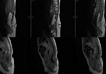 Aneh, Seorang Ibu Dapati Bayinya yang Baru Lahir Miliki Ekor di Pantat