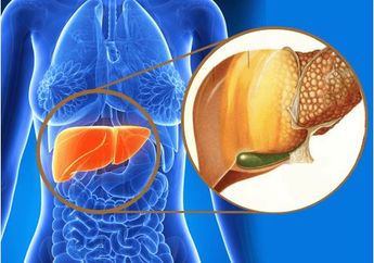 Yuk Kenali Apa Itu Steatohepatitis Non-Alkohol, Salah Satu Penyakit yang Disebabkan Oleh Minyak Bunga Matahari