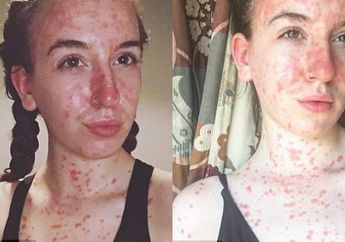 Awas! Psoriasis Siap Menghantui Kulitmu, Inilah Penjelasannya
