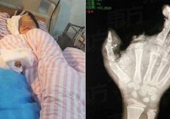 Anak Berusia 12 Tahun Terkena Ledakan dari Ponsel, Jari Tangan Kanan Hancur dan Mata Kanannya Tidak Bisa Melihat Lagi