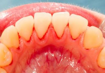Alami Gingivitis? Coba Pengobatan Rumahan Ini, Manjur Banget loh