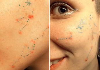 Tetap Pede Meski Jerawatan, Gadis Ini Ubah Jerawatnya Jadi Karya Seni, Dari Bete Jadi Seneng