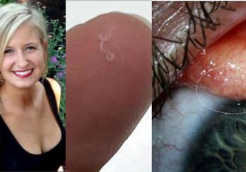 Dikira Bulu Mata Nyangkut, Ternyata Ada Cacing Parasit di Bola Mata Wanita Ini