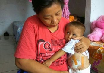 Bayi Iqbal Dari Depok Lahir Tanpa Anus dan Kaki Kiri, Orang Tua Sempat Pikirkan Ini