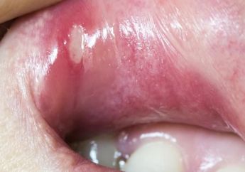 Ini Pendapat Ahli, Terkait Viralnya Surat BPOM soal Albothyl!