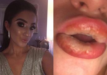 Niatnya Biar Menor Pakai Lipstik, Bibir Seorang Gadis Malah Bengkak Besar