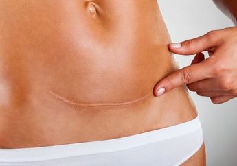 Yuk Intip 6 Fakta dari Histrektomi Prosedur Pengangkatan Rahim