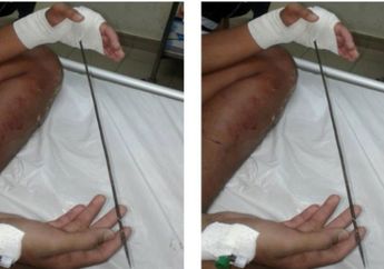 Hendak Menangkap Ikan, Tangan Bocah 17 Tahun Justru Tertancap Tombaknya Sendiri