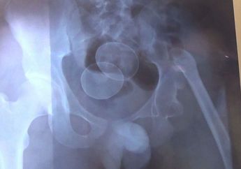 Pernah Viral, Remaja di Sulawesi Ini Kembali Bertelur Lagi