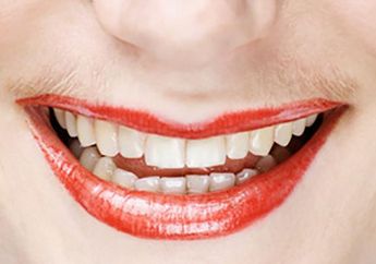 Hilangkan Bulu Halus di Area Bibir Bagian Atas, Sebaiknya dengan Waxing, Threading, atau Laser Hair Removal ya?