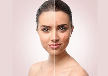 Alami Jerawat Beruntusan, Jangan Khawatir, yuk Hilangkan dengan Cara Mudah Ini