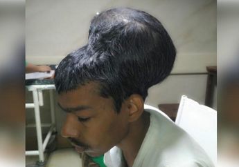 Tumor Otak Terbesar di Dunia Dengan Berat 1,8 Kilogram Milik Pria Ini Berhasil Dioperasi