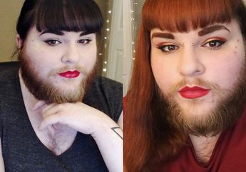 Awalnya Risih Karena Punya Kelainan Rambut, Hidup Wanita Ini Berubah Setelah Bertemu Kekasihnya!